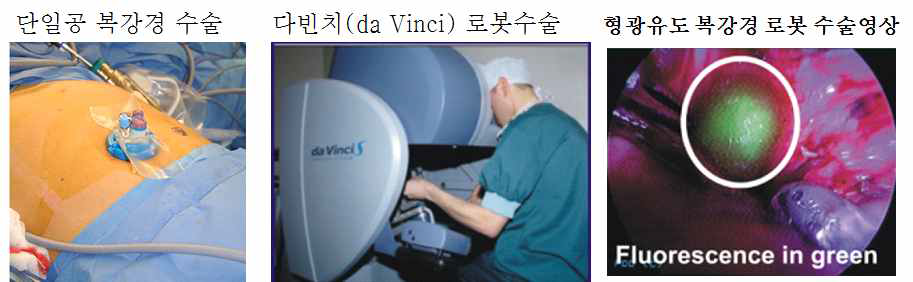 단일공 복강경 수술 (왼쪽), 다빈치 로봇 수술을 하는 모습 (가운데), 형광유도 복강경 로봇 수술 중에 얻은 근적외선/가시광선 형광영상 (오른쪽) [Henk 2011]