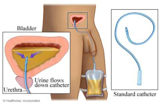 간헐적 도뇨( intermittent urethral catheterization) 방식의 개요도