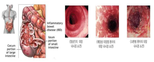 염증성 장질환의 개요