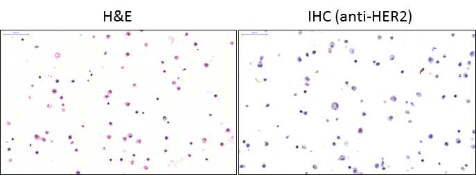 위암환자 종양세포에서 HER2 면역조직화학염색