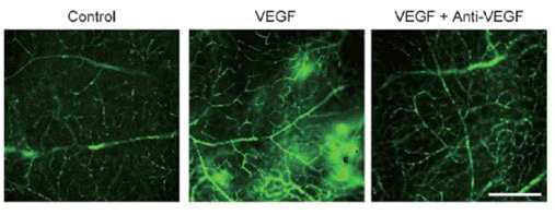 당뇨망막병증 황반부종 관련 유효인자인 VEGF 조절을 통한 혈관 투과성 억제