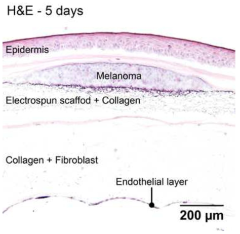 흑색종 군집 및 혈관내피세포가 포함된 피부암 모델