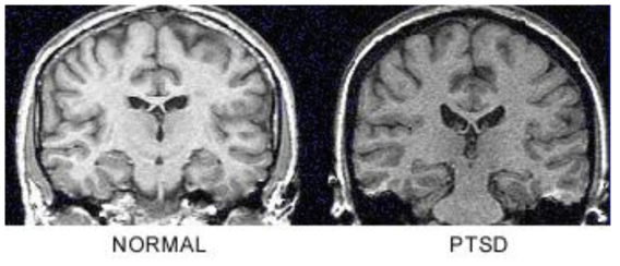 정상인과 PTSD환자 간의 뇌 회백질 volume 차이