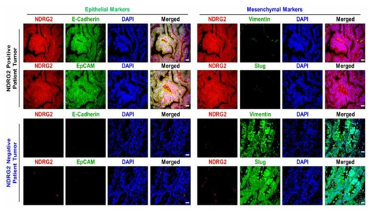 NDRG2 음성 환자에서 EMT 진행의 촉진