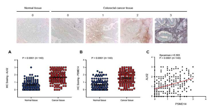 대장암 환자의 TMA의 면역조직화학염색 (IHC)을 통한 대장암 환자 샘플에서 PSMD14 및 ALK2 단백질의 발현 분석