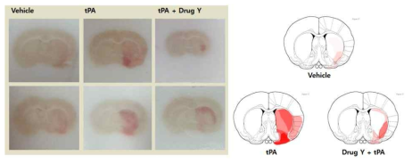 색전성 동물모델에서의 지연성 tPA 처리 (허혈 후 6시간) 후 허혈부위에서의 뇌출혈 증가와 Drug Y에 의한 억제효과