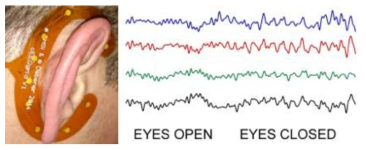 Mastoid에 부착된 전극 (좌)과 측정된 알파파 (우)