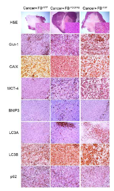 Expression of metabolism related proteins in mouse tumor xenograft. Higher expression of Glut-1, MCT-4, LC3A, and LC3B is noted in mouse tumor xenograft made by injection of MDA-MB-231 cells co-cultured with FB-PDGFRβ or FB-FAP cells than in mouse tumor xenograft made by injection of MDA-MB-231 cells co-cultured with FB-GFP