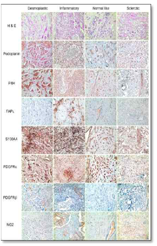 유방암 stromal histologic type에 따른 CAF-related proteins의 발현의 차이