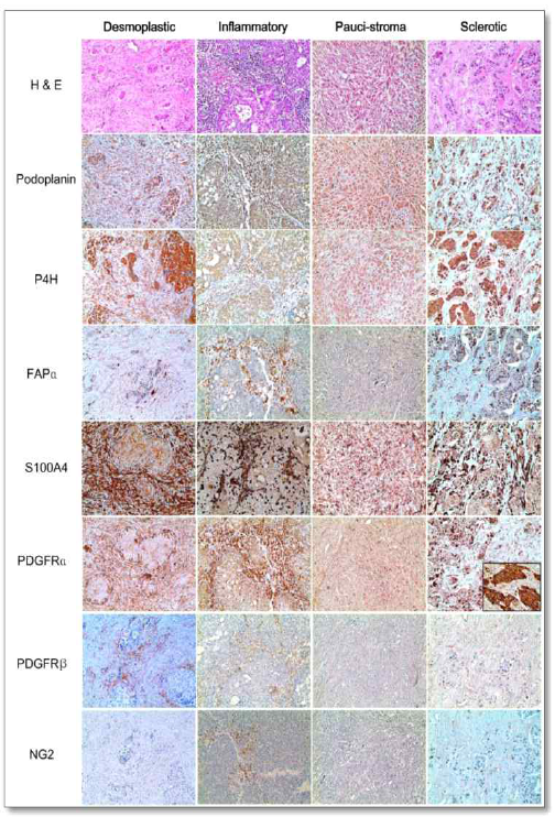 전이성 유방암 stromal histologic type에 따른 CAF-related proteins의 발현의 차이