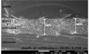 글라스침투 지르코니아와 전장도재간 결합양상연구