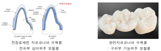 치과용 지르코니아 수복물의 종류