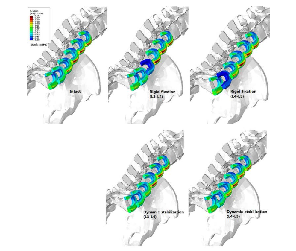 추간판의 윤상인대의 응력(von-mises) 분포 비교