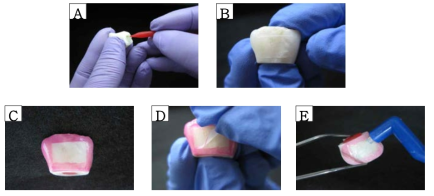 Preparation of bovine teeth for application of fluoride varnish. A. Blocking the pulp chamber of bovine teeth with utility wax. B. Attaching a 10 × 7 mm tape to clean buccal surface. C. Applying nail varnish on the tooth surface surrounding the tape. D. Removing the tape from the tooth. E. Applying fluoride varnish on the tooth surface where the tape was removed
