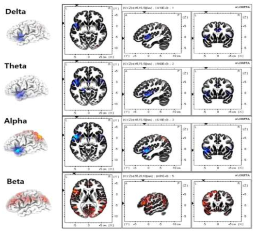 음성 인식 뇌파와 음성 상상 뇌파의 비교를 통한 sLORETA 이미지
