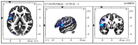 무음 자극과 모음 자극 간의 음성 상상 뇌파 비교를 통한 β 영역에서의 sLORETA 이미지