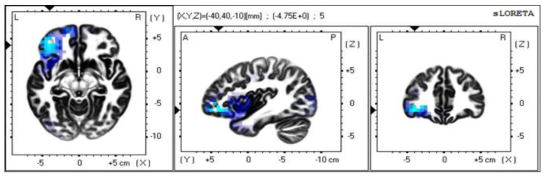 무음 자극과 모음 자극 간의 음성 상상 뇌파 비교를 통한 γ 영역에서의 sLORETA 이미지