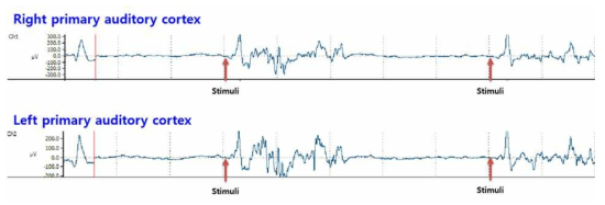 양측 primary auditory cortex에서 관찰된 ERPs