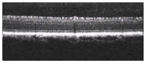 비글 눈의 망막 단면 OCT 영상