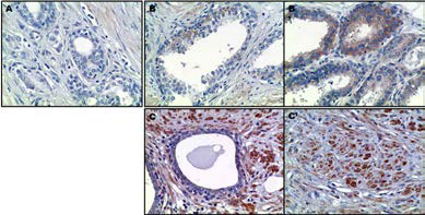 전립선암 환자 조직에서 ETV5 발현에 대한 면역조직화학염색. A) 인간의 정상 전립선 상피세포에서 ETV5 발현은 낮음, B-B’) PIN (prostatic intraepithelial neoplasia)의 전립선 상피세포에서는 ETV5의 발현이 다소 증가함. C-C’) Prostatic adenocarcinoma의 경우, 정상조직 (C) 보다 암 조직 (C‘)에서 ETV5의 발현이 크게 증가함
