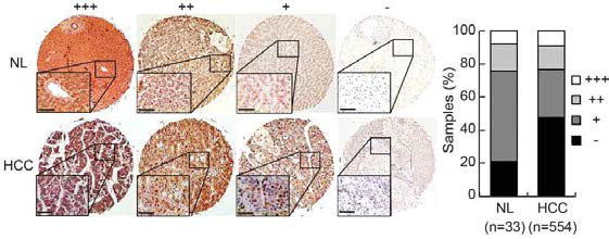 Tissue microarray를 이용한 정상과 간암 조직에서의 CIC 단백질 발현양 분석