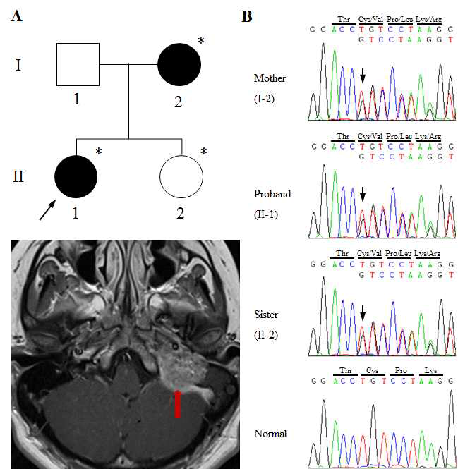 난청과 함께 박동성 이명증상과 부신경절종을 동반하는 환자의 가계에서 발견된 SDHB 유전자의 틀이동 돌연변이(p.C253VfsX5)