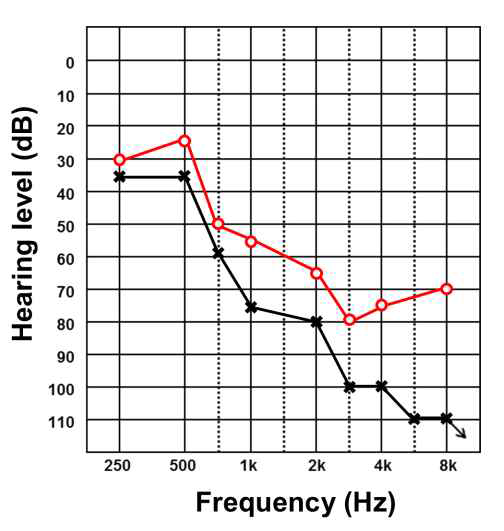 DIAPH1 유전자에 돌연변이를 가지는 환자의 청력도