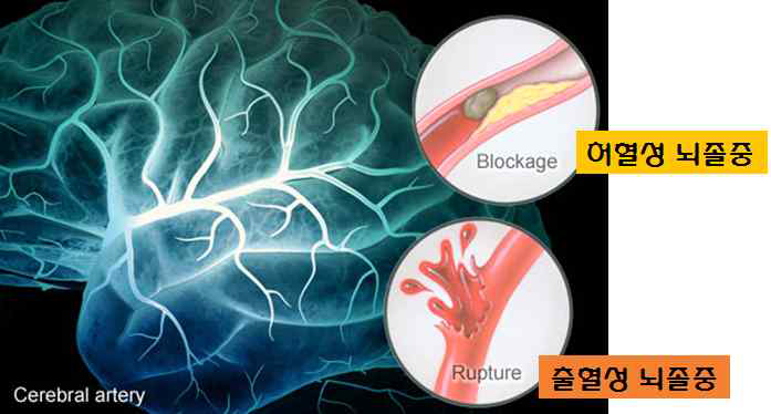 허혈성 뇌졸중과 출혈성 뇌졸중