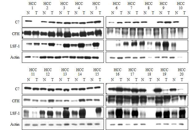 간암 환자조직내에서의 보체와 TFCP2(LSF-1)의 단백질 발현량 분석