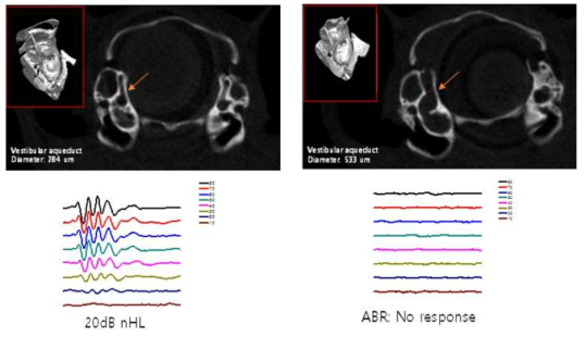 Micro CT and ABR findings in human WT- and p.H723R pendrin knock-in mouse