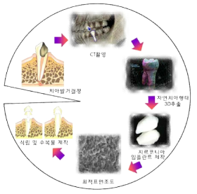 즉시 식립형 자연치아 형태 지르코니아 임플란트의 프로토콜 다이어그램