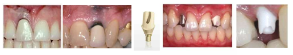 티타늄 소재의 비심미성으로 인해 도입된 지르코니아 Abutment