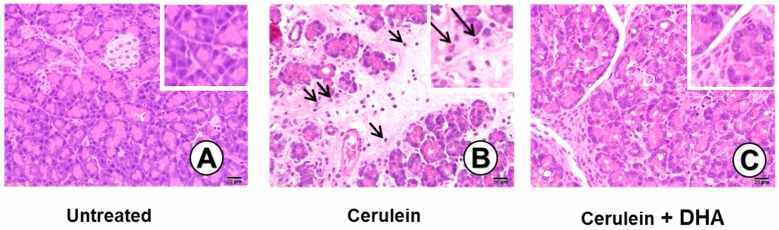 흰쥐에 cerulein 및 오메가 3 지방산 (DHA)을 투여한 후, 췌장조직을 section한 뒤 HE stain한 후 조직학적 변화를 관찰함. (A) 정상 췌장 조직 (untreated) (B) cerulin을 투여 하여 급성 췌장염을 유발한 흰쥐의 췌장조직 (C) cerulin과 DHA을 투여한 흰쥐의 췌장조직