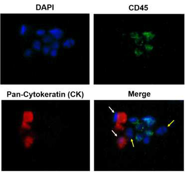 Adjuvant breast cancer patient로부터 추출한 blood sample을 µ-MixMACS chip을 통해 분리해낸 cell의 형광이미지