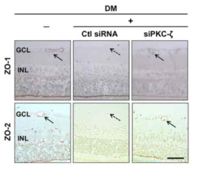 당뇨망막에서 PKCzeta조절을 통한 망막혈관내피세포에서 치밀이음부단백질 및 세포사이결합단백질 조절 인자 회복 확인