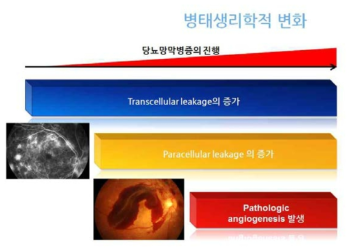 당뇨망막병증 진행에 따른 병태생리학적 변화와 세포막 혈관투과성 증가 (transcellular leakage) 및 세포사이 혈관투과성 증가 (paracellular leakage), 신생혈관 생성과의 연관 관계