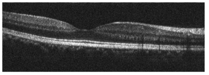 OCT의 성능을 평가하기 위하여 얻은 사람의 망막 단면 구조 영상