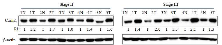 정상 및 대장암 조직에서 Carm1의 발현 관찰