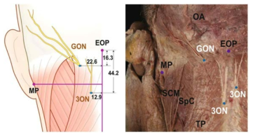 GON과 3ON이 등세모근을 관통하는 위치