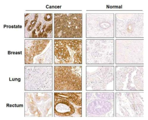 암환자 TMA (Tissue Microarray)에서 PPEF-1의 immunohistochemistry 결과