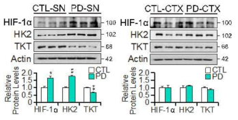 파킨슨 환자 중뇌흑질 및 대뇌피질에서 HIF-1α, HK2, TKT의 단백질 발현 수준 확인 및 정량 (PD 환자 중뇌, 대뇌피질)