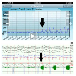 Quit snoring 어플리케이션 (Pointer Software Systems) 및 수면다원검사 결과 비교 (코골이 시작 지점과 횟수가 거의 일치)