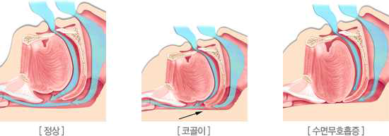 코골이와 수면무호흡(출처: http://www.ulsanhana.com/nose_02.html)