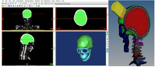 사체 CT 데이터를 활용한 FEM 모델링