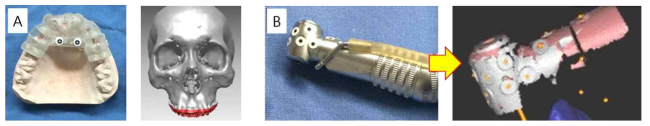 A) 환자의 입 안 스캐닝 자료와 CBCT 자료의 정합 B) 핸드피스의 타깃 3D 스캐닝