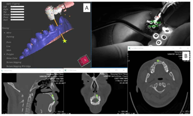 동적 내비게이션 수술장비 시제품 상 A) 동영상과 환자의 입 안 스캐닝 자료에서의 타깃 인식과 B) CBCT 상 드릴 끝(☆)의 위치 구현