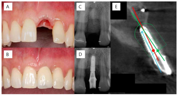임상시험 결과 A, B) 수술 전과 후 임상사진 C, D) 수술 전과 후 치근단 방사선사진 E) 수술 전 계획과 수술 후 결과를 중첩한 CBCT (녹색/적색 - 수술 전/후 임플란트 픽스쳐, 청색 - 드릴)