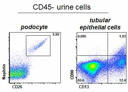 소변 내 사구체 족세포 및 세뇨관 상피세포 존재