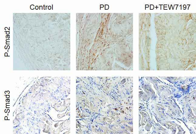 Phospho-Smad2/3 면역화학염색을 통하여 TGF-β 하위신호전달 인자로서 Smad2/3가 phosphorylation 되어 핵안으로 이동 후 ECM molecule들의 발현을 유도하는데, 음경만곡증 유도 모델에서는 p-Smad2/3 발현이 증가한 반면, TEW-7197 투여군에서는 p-Smad2/3 발현이 현저하게 감소됨