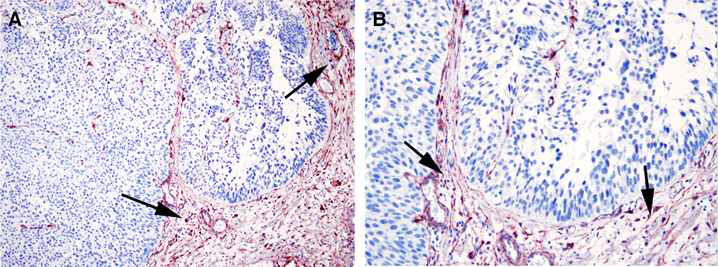 방광암 정상 조직에서 PDGFR-β의 세포내 발현. 방광암 세포가 아니라 기질(화살표)에서 발현됨이 확인됨